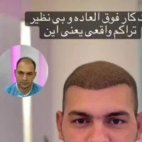 کاشت مو ریش  ابرو و زیبایی