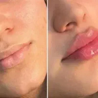 تزریق ژل با تخفیف ویژه فقط برای این هفته