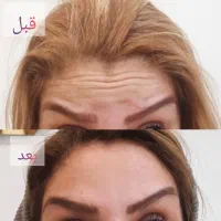 لیزر موهای زائد۲۰۲۵، بوتاکس،فیلر توسط پزشک|خدمات آرایشگری و زیبایی|تهران, جوادیه|دیوار