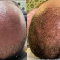 دلت برای موهای پرپشتت تنگ شده راهش اینجاس