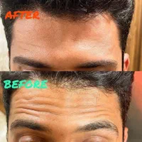 بوتاکس توسط پزشک جهت رفع چین و چروک و لیفت ابرو|خدمات آرایشگری و زیبایی|یزد, |دیوار