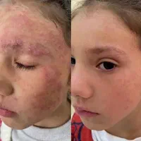 درمان تضمینی پیسی و پسوریازیس|خدمات آرایشگری و زیبایی|مشهد, انقلاب|دیوار