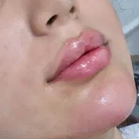 آموزش تزریق ژل بدون سوزن ،بدون هزینه خودت ژل بزن