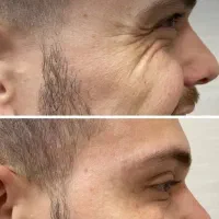 آنزم و مزو تراپی و فیلر و بوتاکس|خدمات آرایشگری و زیبایی|قرچک, مهدیه|دیوار