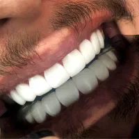 کامپوزیت دندان تضمینی و درجه یک