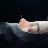 جراحی و عمل زیبایی بینی ( رینو پلاستی )