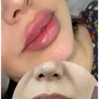 جشنواره تخفیف بوتاکس|خدمات آرایشگری و زیبایی|قم, صفاشهر|دیوار