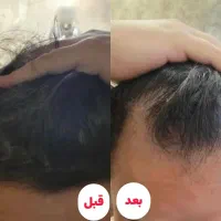 قطع ریزش مو و پرپشتی مو فقط با تکنیک اکسونیک|آرایشی، بهداشتی، درمانی|بوشهر, |دیوار