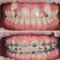 ارتودنسی دیجیتال کلیه سنین - از دم قسط ۱۲ ماهه