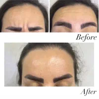 تزریقات فیلر و بوتاکس توسط پزشک|خدمات آرایشگری و زیبایی|تهران, جوادیه|دیوار