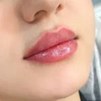 تزریق فیلر بادی بدن۱۰۰هزار