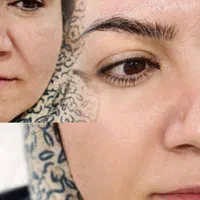 (کلینیک دنا) تنها هایفو۱۲بعدی یاسوج|خدمات آرایشگری و زیبایی|یاسوج, |دیوار
