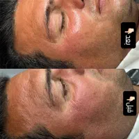 پاکسازی ۱۲مرحله با هدیه درما ۱۹۸ تومان( کلینیک)|خدمات آرایشگری و زیبایی|بیرجند, |دیوار