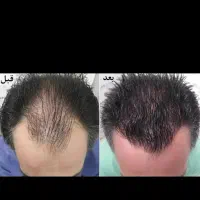 prp و مزوتراپی مو و صورت