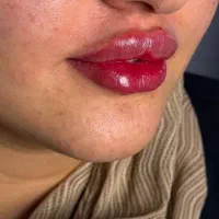 جشنواره زیبایی((ژل وبوتاکس))به مناسبت یلدا