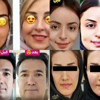 پرکننده طبیعی صورت