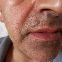برداشتن خال زگیل و میخچه با محلول صدرصد گیاهی|آرایشی، بهداشتی، درمانی|ایذه, |دیوار