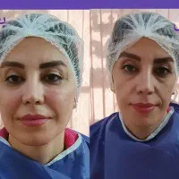 تزریق ژل و بوتاکس تزریق چربی