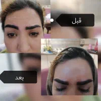 بوتاکس. فیلر. مزوتراپی. فشیال|خدمات آرایشگری و زیبایی|تهران, زاهد گیلانی|دیوار