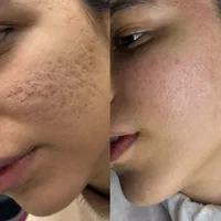 برداشت لک و فرو رفتگی صورت