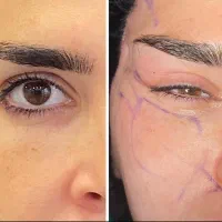 لیفت شقیقه و گونه و کل صورت و تخلیه غبغب