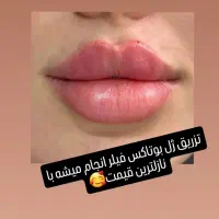 مدل برای ژل بوتاکس