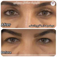 پلفارو پلاستی /ساکشن غب غب/ ابدو پلاستی/مینی ابدو