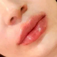 تزریق فیلر ژل وبوتاکس فشیال|خدمات آرایشگری و زیبایی|تهران, ائمه اطهار|دیوار