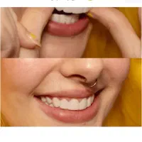 لمینت دندان