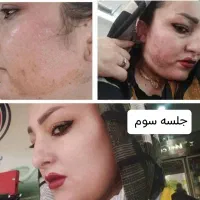 لیزرمو خانم300آقا600ریموتتوخال ژل بوتاکس لک پوستی|خدمات آرایشگری و زیبایی|نجف‌آباد, ویلاشهر|دیوار