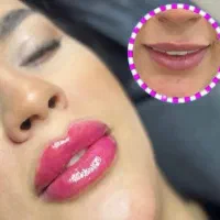 تزریق بوتاکس فیلر انزیم prp مزوتراپی جوانسازی|خدمات آرایشگری و زیبایی|کرمانشاه, |دیوار