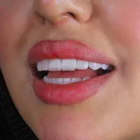 ونیر کامپوزیت - لمینت سرامیکی