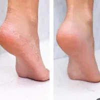 پدیکور