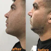 تزریق ژل ،بوتاکس ،لیزر موهای زائد، ساکشن غبعب|خدمات آرایشگری و زیبایی|تهران, صد دستگاه|دیوار