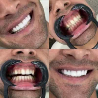 کامپوزیت دندان طرح لبخند جرمگیری بلیچینگ پالیش