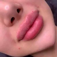 تزریق ژل لب .زاویه فک . بوتاکس. فیلر چانه.