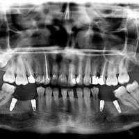 ایمپلنت با شرایط ویژه|خدمات آرایشگری و زیبایی|ارومیه, |دیوار