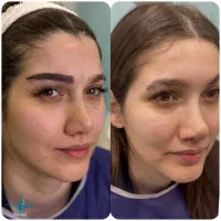 میکرو کاشت ابرو کلینیک ونوس ۱۴،۹۰۰