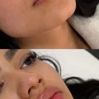 فیلر بوتاکس پی ار پی