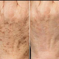 لیزر تتو ،ریمو،مربن تراپی ،خالبرداری|خدمات آرایشگری و زیبایی|شیراز, قصرالدشت|دیوار