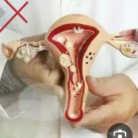 درمان مشکلات رحم بانوان