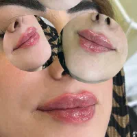 تزریق ژل،لیزر،بوتاکس