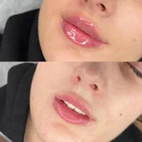 آف ویژه تزریق ژل و بوتاکس|خدمات آرایشگری و زیبایی|یاسوج, |دیوار