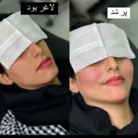 تخفیفات ژل وبوتاکس ومزوژل به مناسبت یلدا|خدمات آرایشگری و زیبایی|قم, زنبیل آباد|دیوار