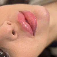 فیلر و بوتاکس و فشیال