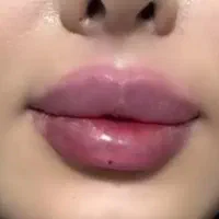 تزریق ژل و آنزیم غبغب وبینی وتزریق آنزیم تخلیه ژل|خدمات آرایشگری و زیبایی|اردبیل, |دیوار