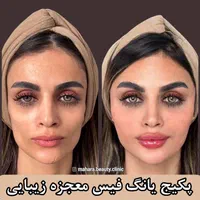 ژل آنزیم لیفت نخ عمل بینی هایفو مزو بوتاکس لاغری|خدمات آرایشگری و زیبایی|مشهد, هفت تیر (حافظ)|دیوار