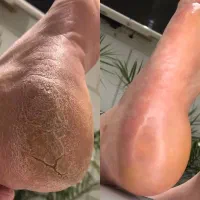 پدیکور وکفسابی پا به مدت محدود ده نفر اول