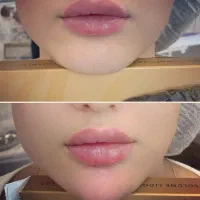 بمب تخفیف تزریق ژل و فیلر و اگزوزوم|خدمات آرایشگری و زیبایی|شیراز, نصر|دیوار
