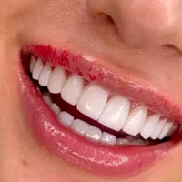 کامپوزیت دندان عصبکشی انواع روکش